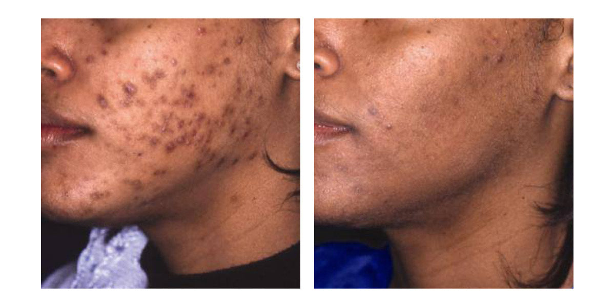 Before And After Vivant Skin Care before and after vivant skin care