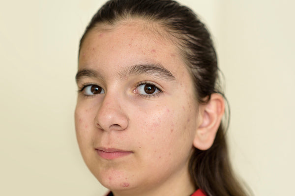 Preteen girl with acne on soft yellow background