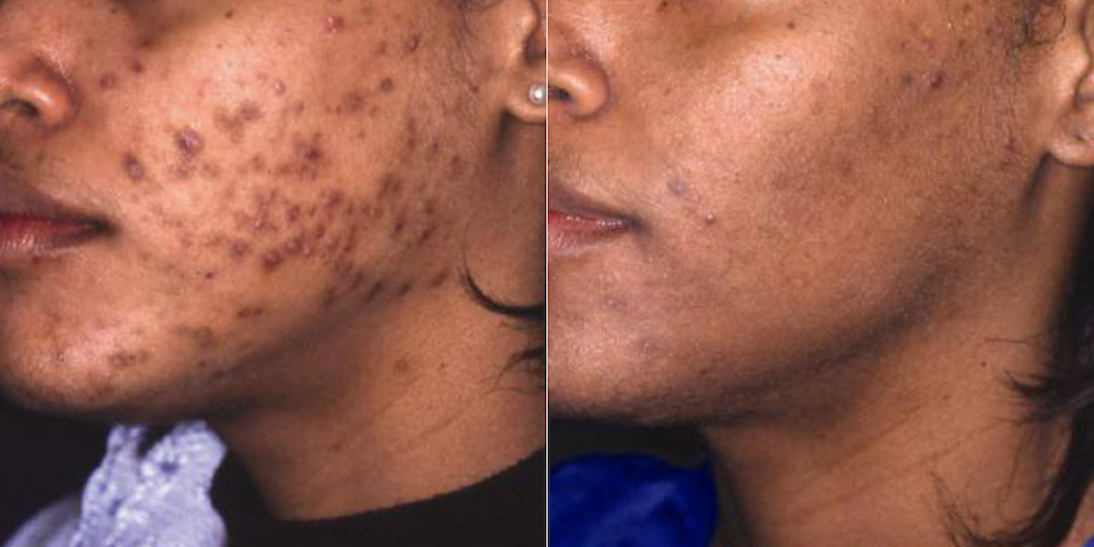 Before and after photos of a dark skin woman with dark spots from acne scars.