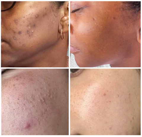 Before and After Photos - Mandelic Acid