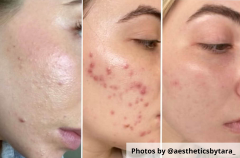 acne purging before and afters