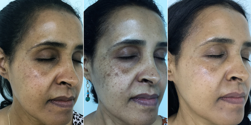 Samia before and after photos showing how dark spots get darker before they get lighter 