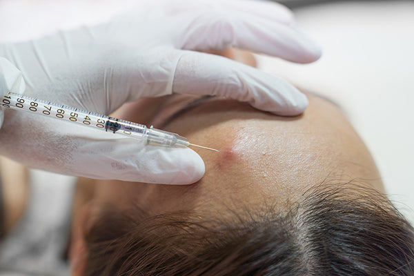 Should You Get a Steroid Shot for Cystic Acne?