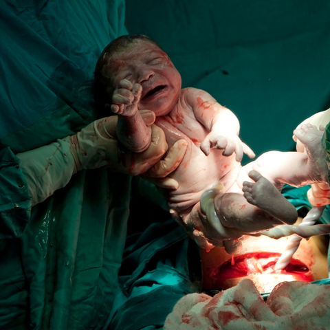 cesarean