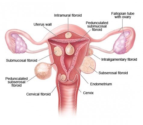 Types and locations of fibroids