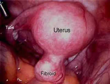 Fibroids