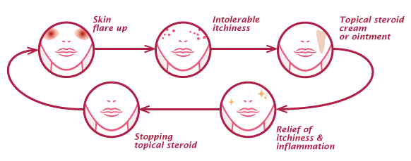 eczema vicious cycle