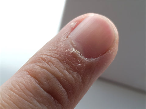 cjs-damaged-dry-finger-cuticle
