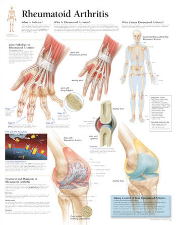 2155-08 Understanding Rheumatoid Arthritis – Denoyer-Geppert Science