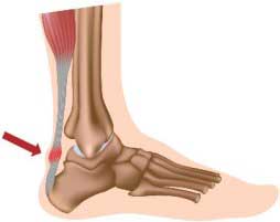 Achilles tendinitis and tendonitis pain relief from Active650 Total Ankle Support
