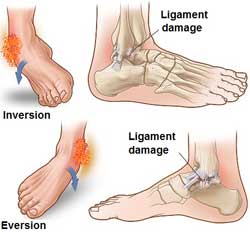 Ankle sprains and ligament damage