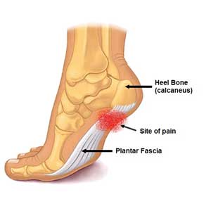 Foot pain, plantar fascia pain and plantar fasciitis