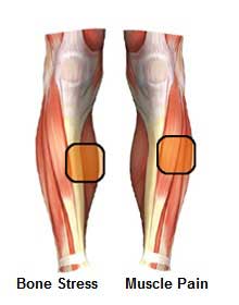 Shin splint pain in muscle and bone