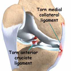 Anterior cruciate ligament ACL tear and Medial cruciate ligament MCL injury