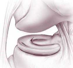 Knee pain caused by meniscus tears