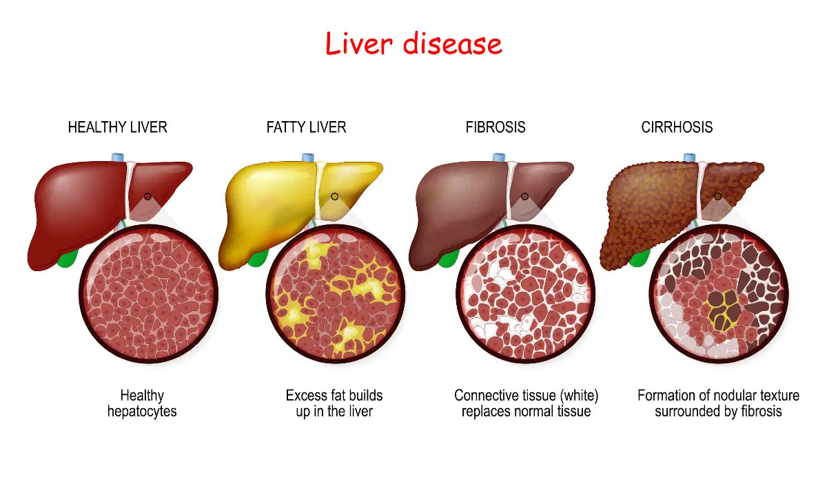 Liver Disease