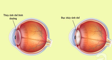 bệnh đục nhân mắt