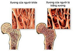 loãng xương sớm