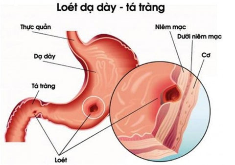 bệnh loét dạ dày ở từng nhóm máu