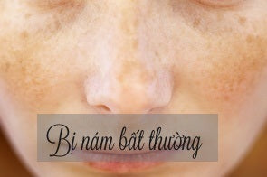 bị nám do gan nhiễm độc