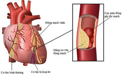 rối loạn chuyển hóa lipid máu