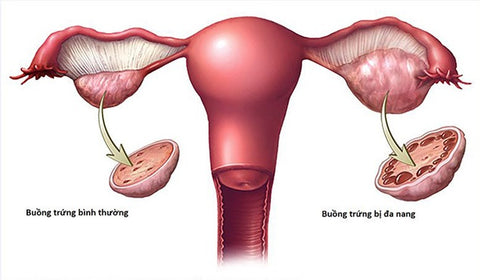 buồng trứng đa nang