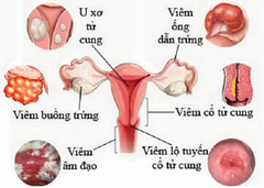 viêm nhiễm phụ khoa ảnh hưởng đến sức khỏe phụ nữ