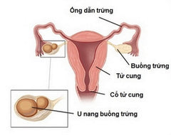 u nang buồng trứng 