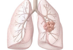 dấu hiệu ung thư phổi