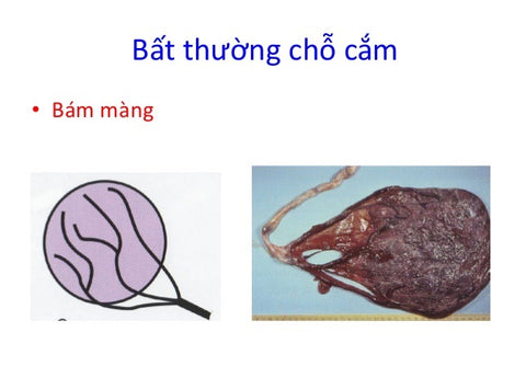 dây rốn bám màng