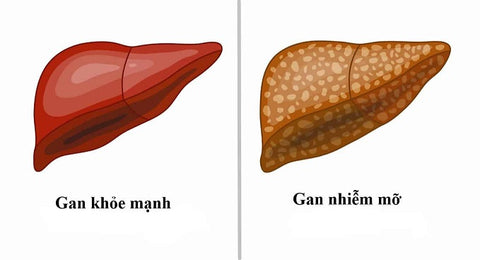 đề phòng gan nhiễm mỡ