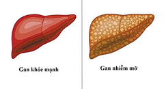 nguyên nhân khiến gan nhiễm mỡ