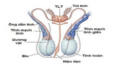 giãn tĩnh mạch thừng tinh