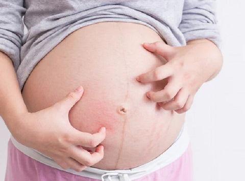 khắc phục ngứa khi mang thai