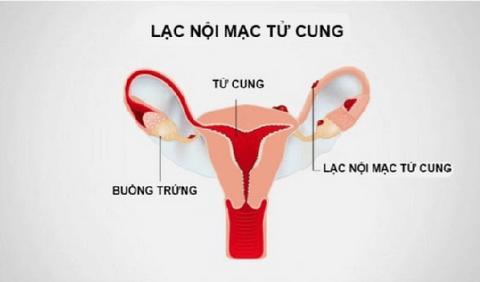 lạc nội mạc tử cung