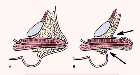 lún dương vật ở trẻ em 