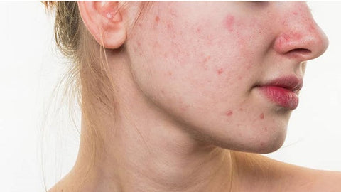mụn nội tiết cho hormone 