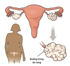 vô sinh do rối loạn phóng noãn