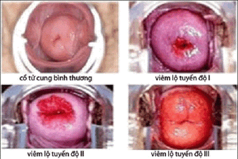 nguyên nhân viêm lộ tuyến tử cung