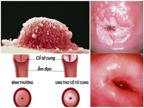 nhiễm HPV