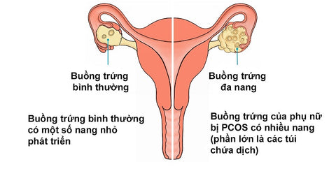 ovaboost hỗ trợ diều trị buồng trứng đa nang và tăng chất lượng trứng