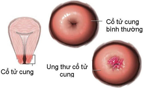 phát hiện ung thư bằng cách nào