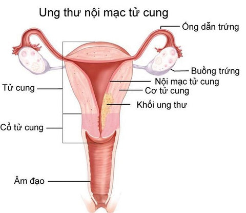 phát hiện ung thư bằng cách nào