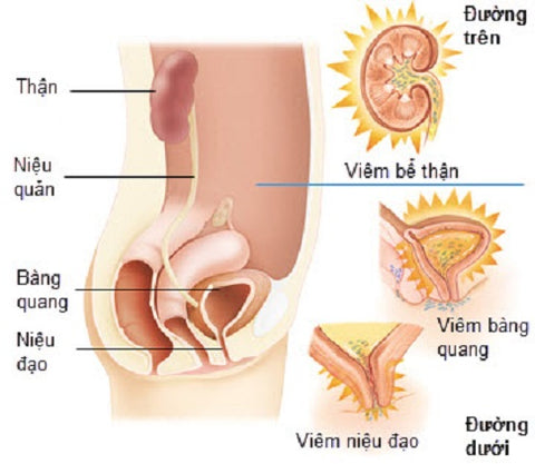 viêm đường tiết niệu khi mang thai