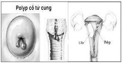 bệnh polyp tử cung