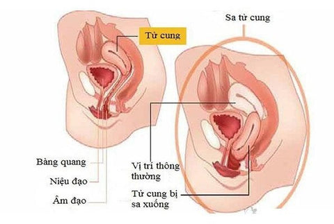 bệnh sa sinh dục 