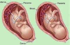 sốt xuất huyết khi mang thai