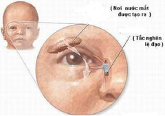 tắc tuyến lệ ở trẻ em