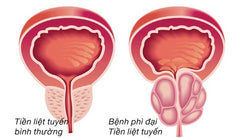 tình dục ở người phì đại tuyến tiền liệt 