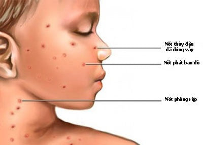 trẻ bị nổi mẩn đỏ do nhiễm virus